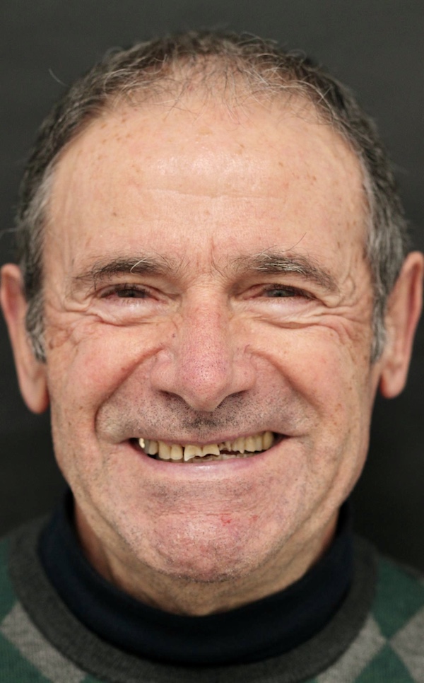 Protesi dentale additiva per il tuo sorriso
